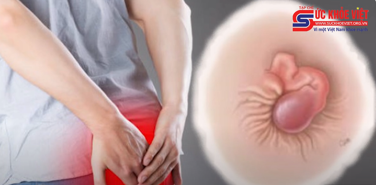 Bệnh trĩ có thể tự khỏi?