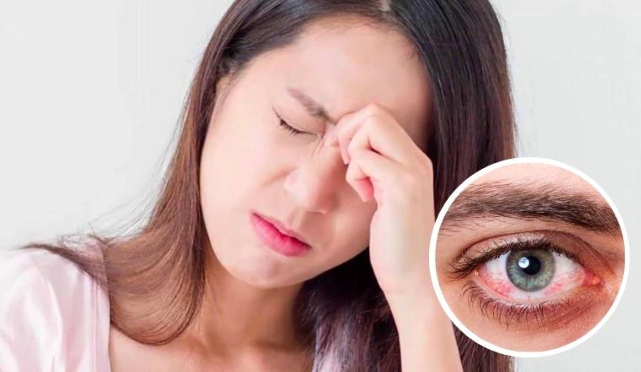 Đau mắt đỏ mùa tựu trường: Bác sĩ khuyến cáo cách phòng tránh