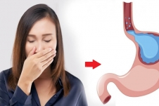 Thấy 4 dấu hiệu này nên đi khám trào ngược dạ dày thực quản sớm